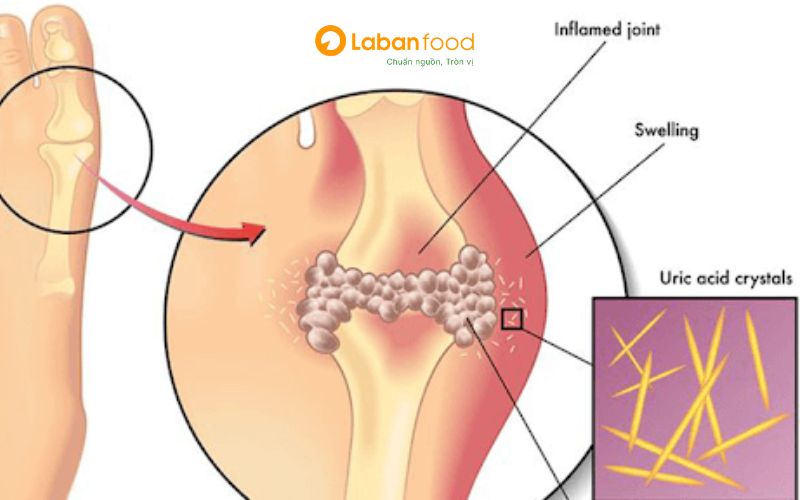 ăn nhiều thịt bò có bị gút không