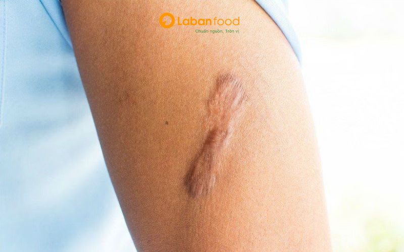ăn thịt bò có bị sẹo thâm không