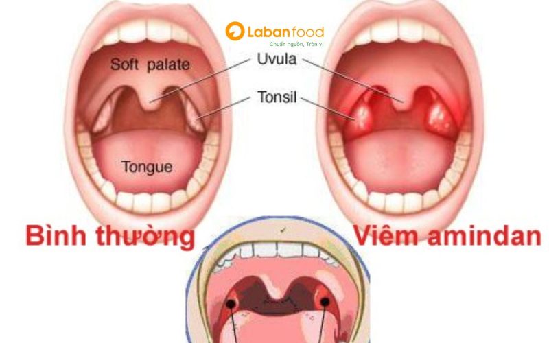 viêm amidan ăn thịt bò được không