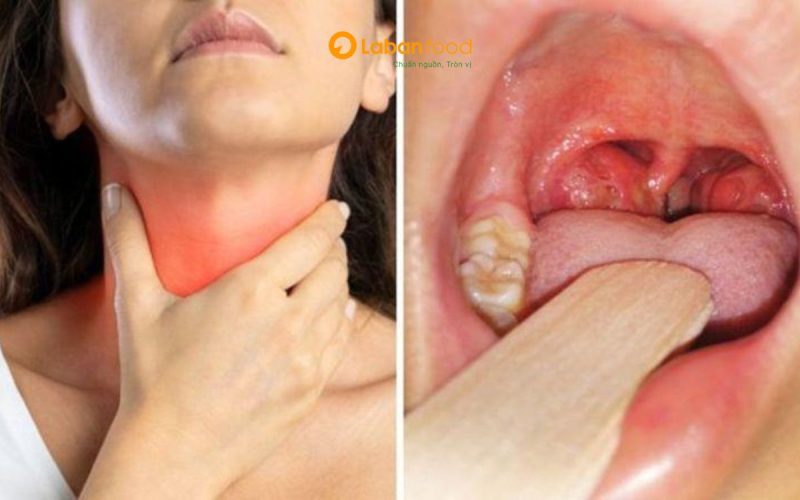 viêm amidan ăn thịt bò được không