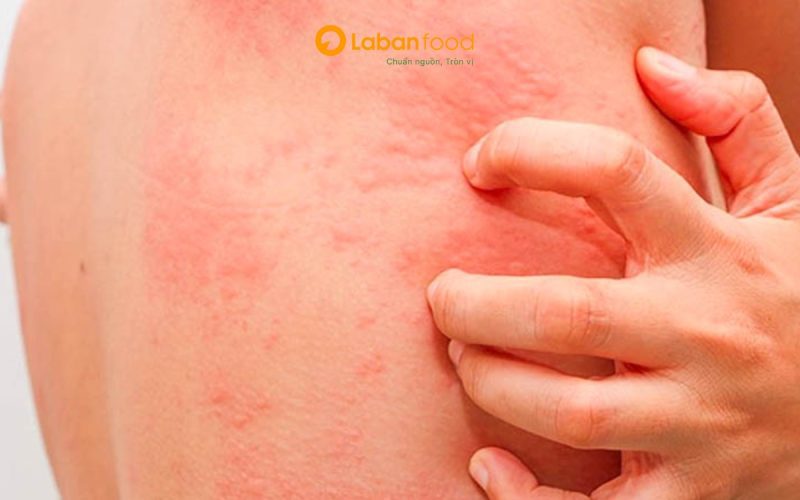 ăn thịt bò bị ngứa