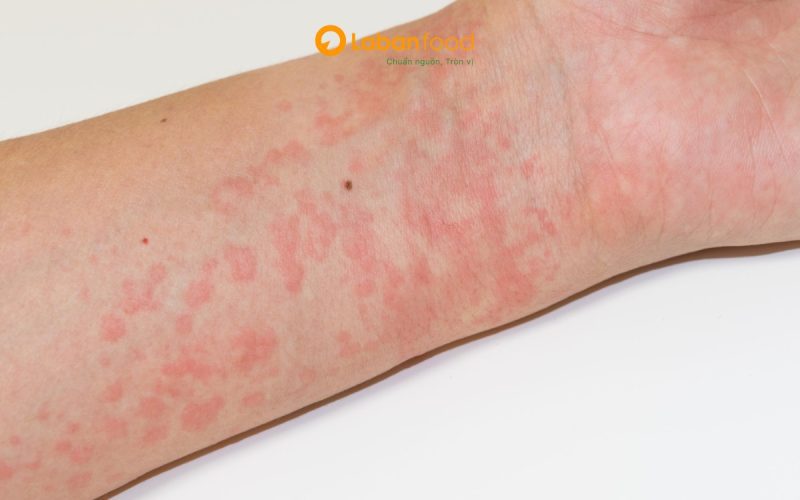 bị ngứa có nên ăn thịt bò