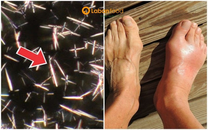 ăn thịt bò bị nhức chân