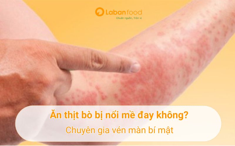 ăn thịt bò bị nổi mề đay