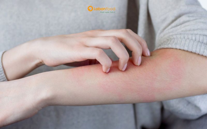 ăn thịt bò bị nổi mề đay