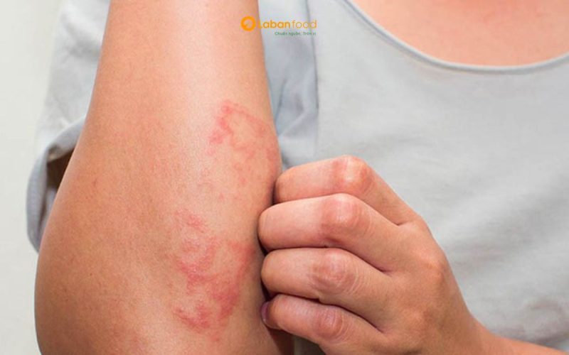 ăn thịt bò bị nổi mề đay