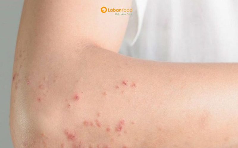 ăn thịt bò bị nổi mề đay