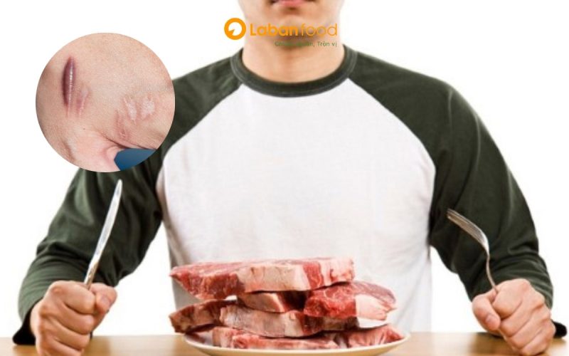 ăn thịt bò có bị sẹo lồi không