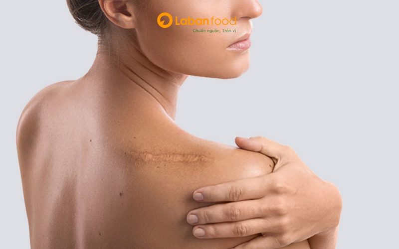 ăn thịt bò có bị sẹo lồi không