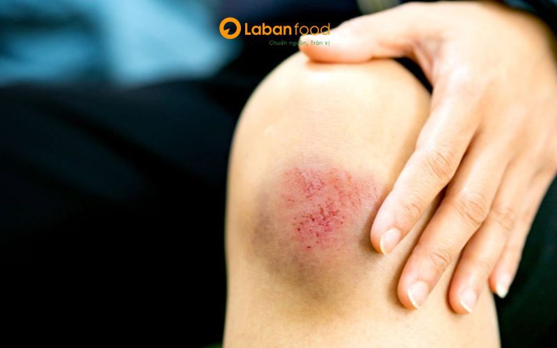 thịt bò có làm lồi sẹo không