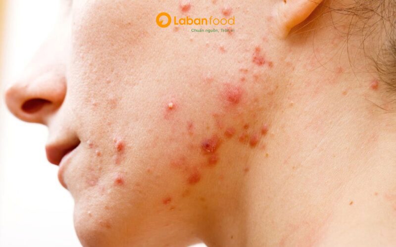 ăn thịt bò bị sẹo lồi