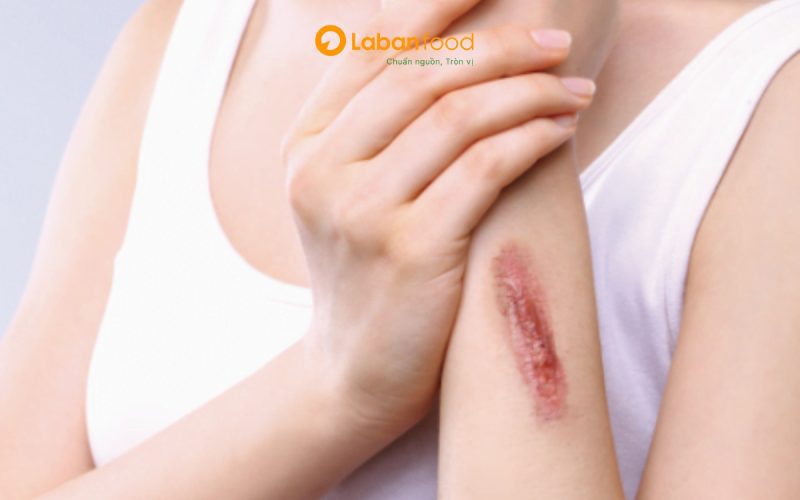 ăn thịt bò có bị sẹo lồi không