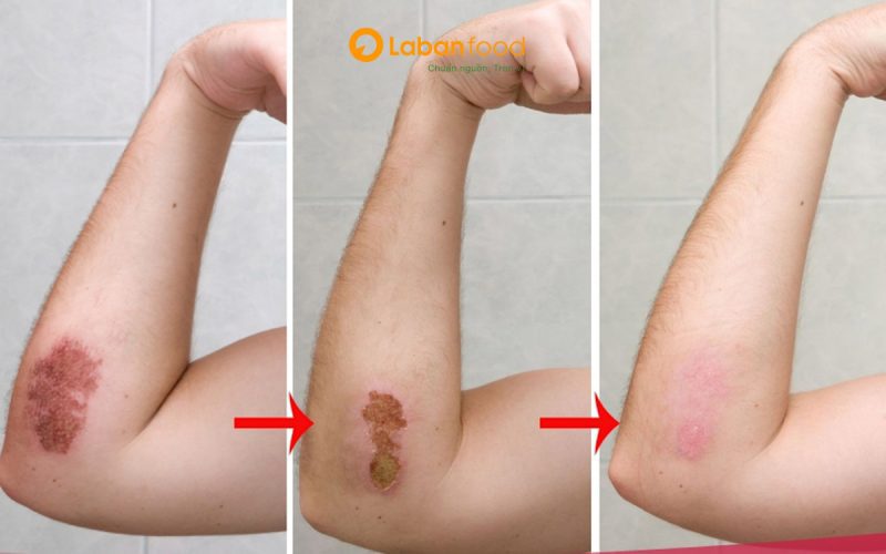 ăn thịt bò có bị sẹo lồi không