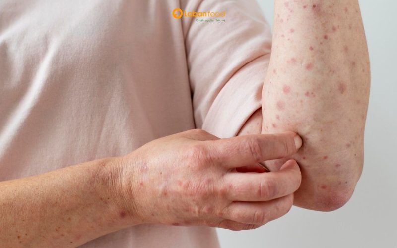 bị thủy đậu có được ăn thịt heo không