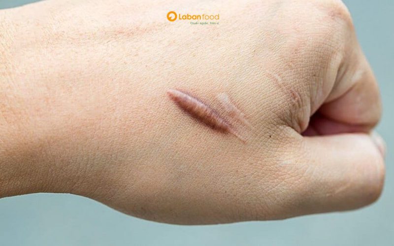 bị vết thương hở có nên ăn thịt bò không