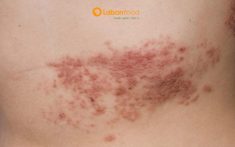 bị zona có được ăn thịt bò không