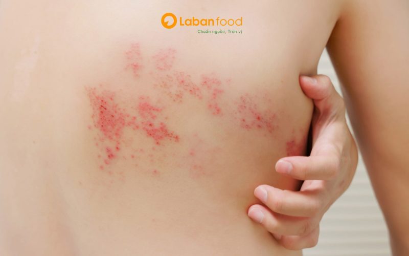 bị zona có được ăn thịt bò không