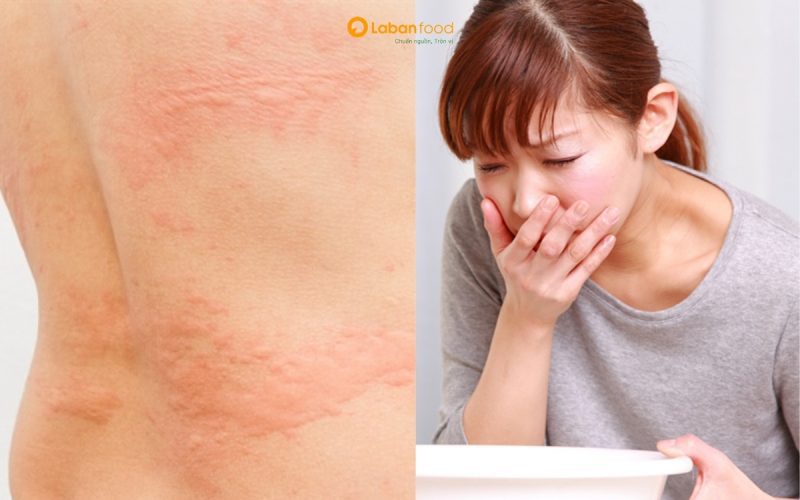 biểu hiện dị ứng thịt bò