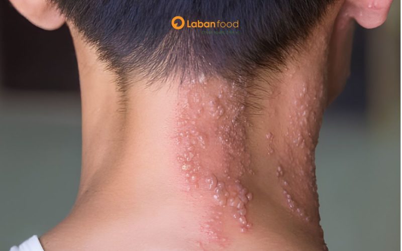 bị zona kiêng ăn thịt gà