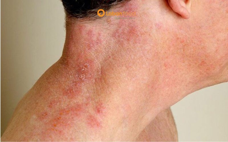 bị zona kiêng ăn thịt gà