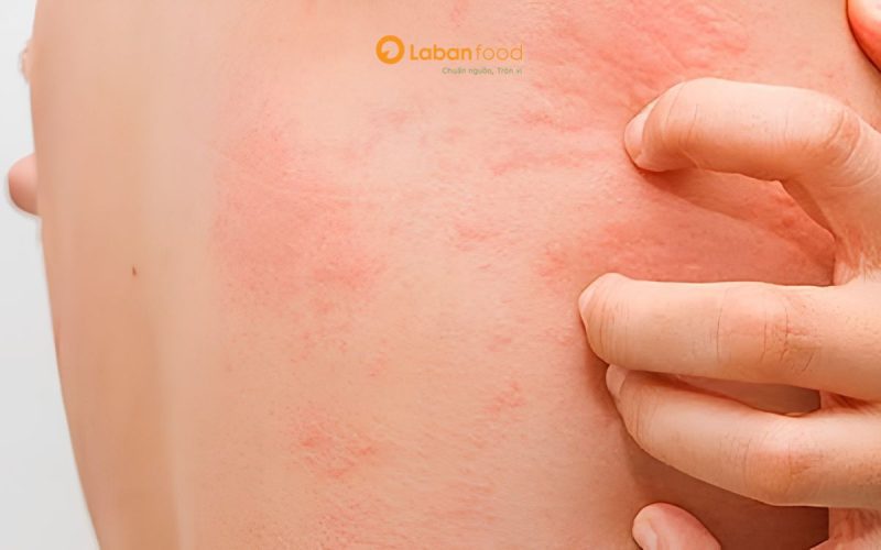 bị zona kiêng ăn thịt gà
