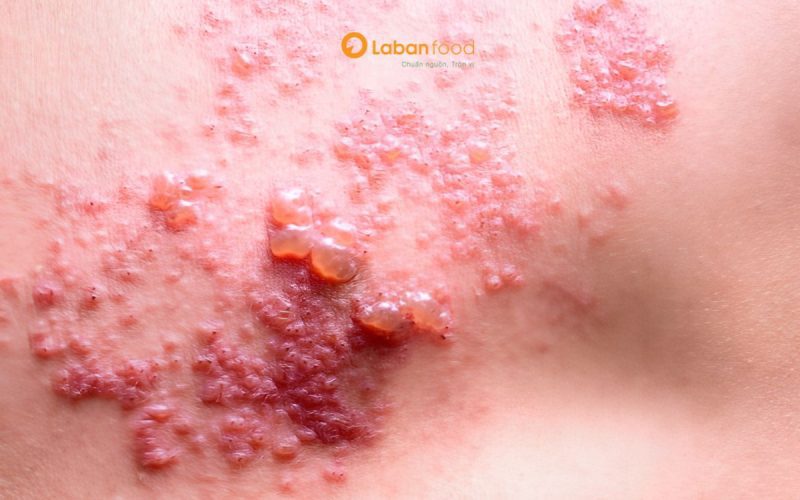 bị zona kiêng ăn thịt gà