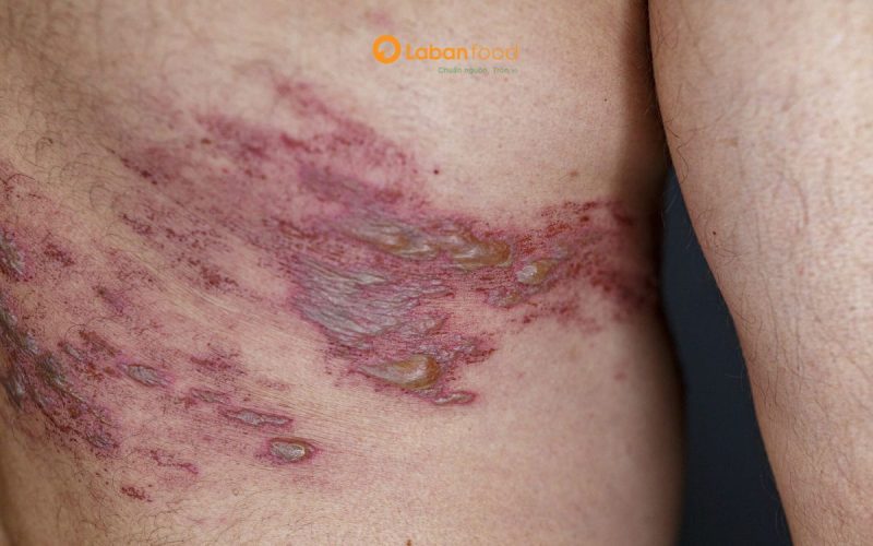 bị zona kiêng ăn thịt gà